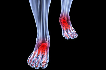Arthritic foot and ankle care treatment, foot arthritis treatment in the Evanston, IL 60202 area
