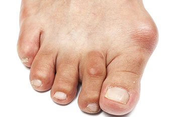 Bunions treatment in the Evanston, IL 60202 area