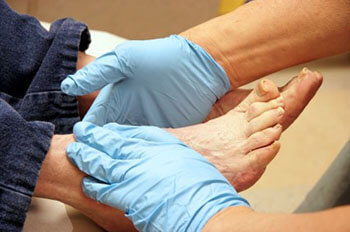 Diabetic foot treatment and care, Diabetic Ulcers Treatment & Management in the Evanston, IL 60202 area