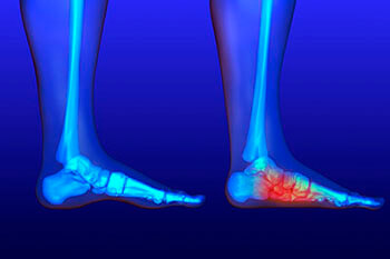 Flat Feet Deformities