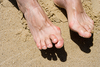 Hammertoes & Mallet Toes treatment in the Evanston, IL 60202 area