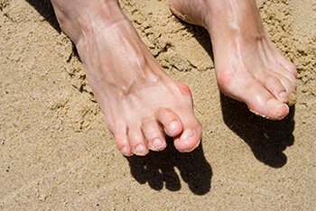 Hammertoes Treatment