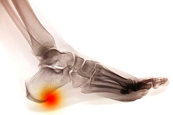 Heel Spurs Treatment in the Evanston, IL 60202 area