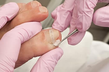 Ingrown Toenails Diagnosis and Treatment