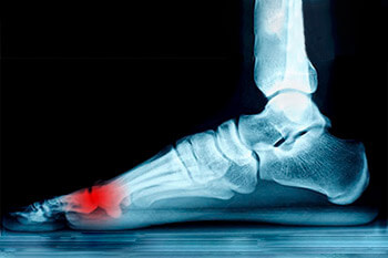 Mortons neuroma treatment in the Evanston, IL 60202 area