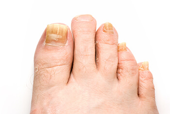 Fungal toenails diagnosis and treatment in the Evanston, IL 60202 area