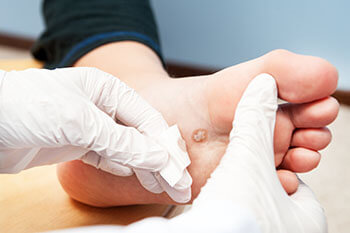 Plantar warts treatment in the Evanston, IL 60202 area