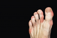 Causes of Gout