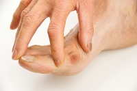 What Are Bunions?