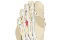 Pain Between the Toes May Indicate Morton’s Neuroma